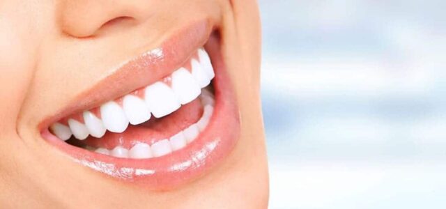 Carillas de zirconio Carillas dentales zirconio