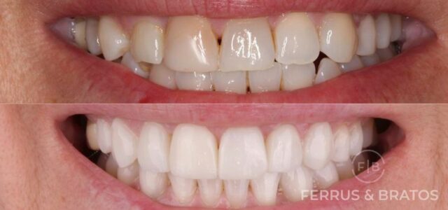 sonrisa con carillas