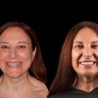 Paciente antes y despues del proceso de colocacion de las carillas dentales