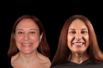 Paciente antes y despues del proceso de colocacion de las carillas dentales