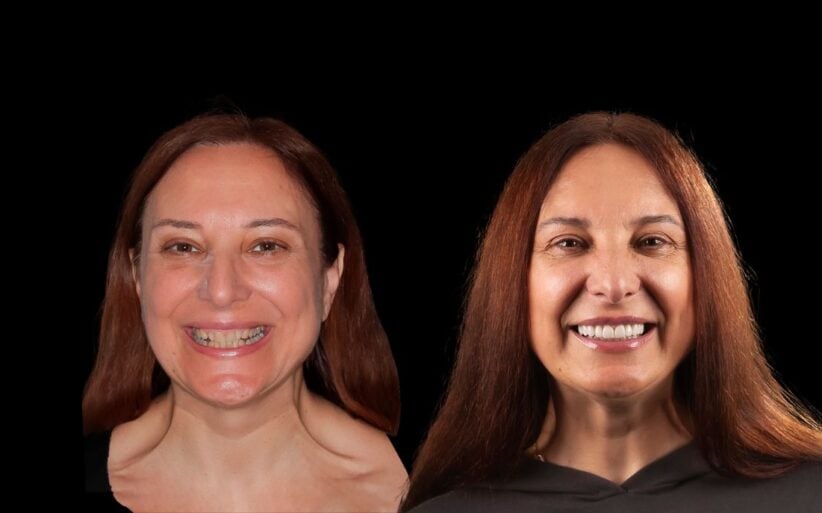 carillas-dentales- proceso-colocacion Paciente antes y despues del proceso de colocacion de las carillas dentales