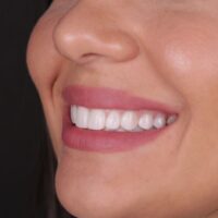 carillas dentales a medida