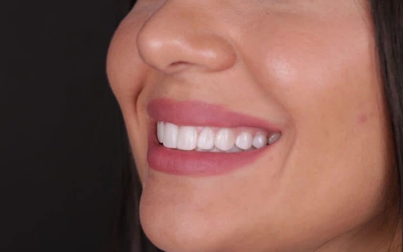 carillas dentales a medida