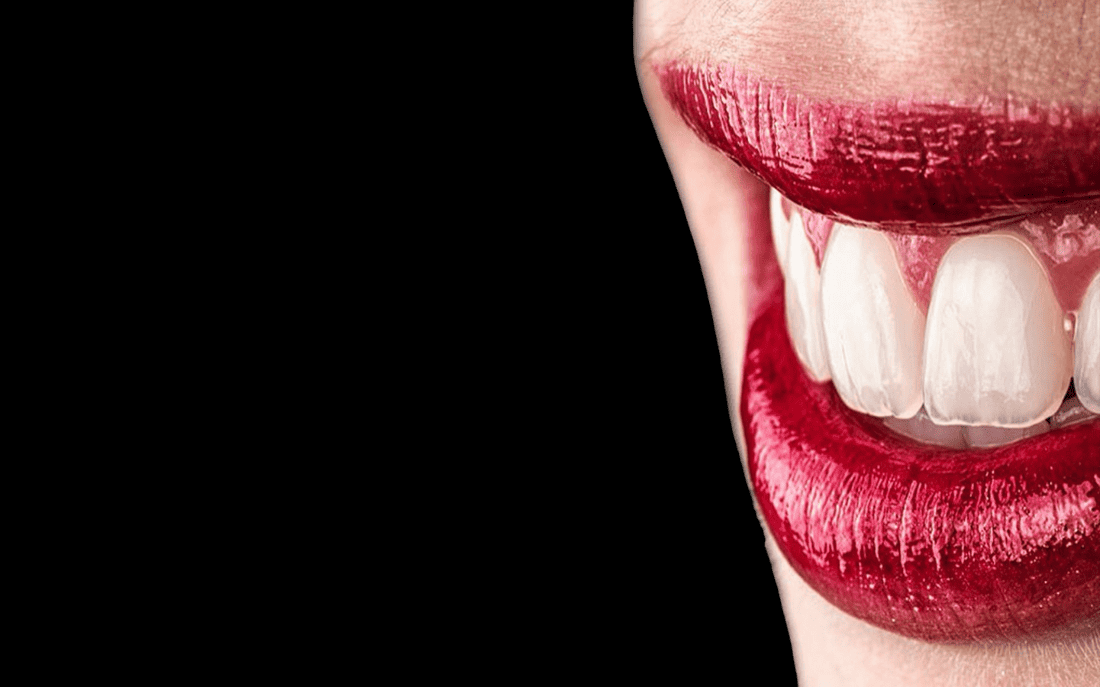 Carillas dentales: 5 Curiosidades que quizás no sabías
