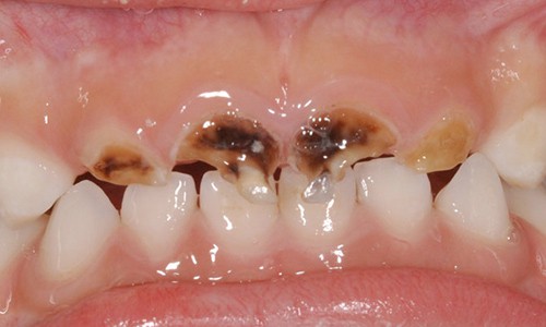 Manchas en dientes de leche: causas y tratamiento | Ferrus & Bratos