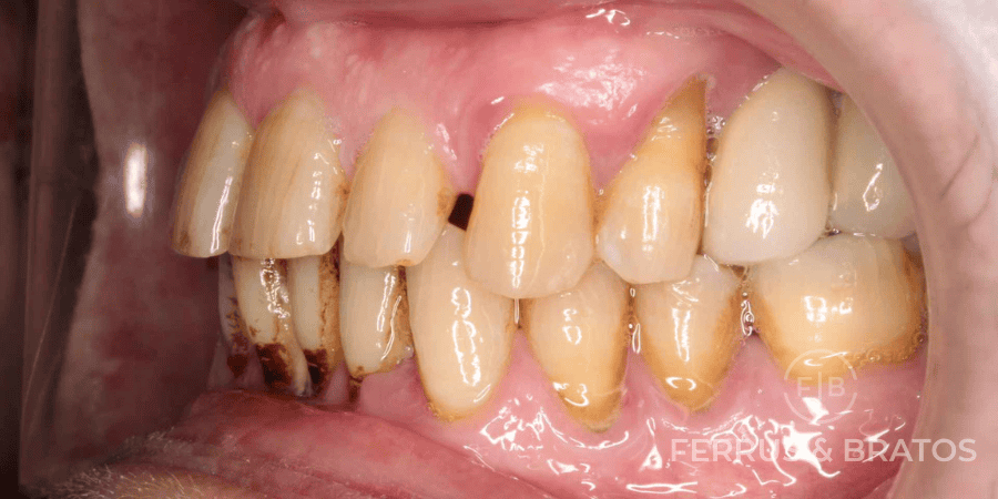 caso de piorrea leve