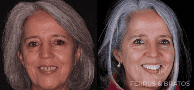 caso real implantes dentales