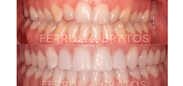 Cambio real INvisalign