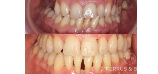 Fotos de antes y despues de piorrea