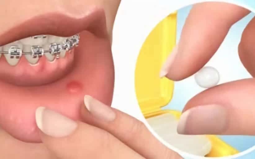 Cera dental para ortodoncia: aprende cómo usarla