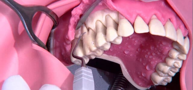 Cirugía periodontal