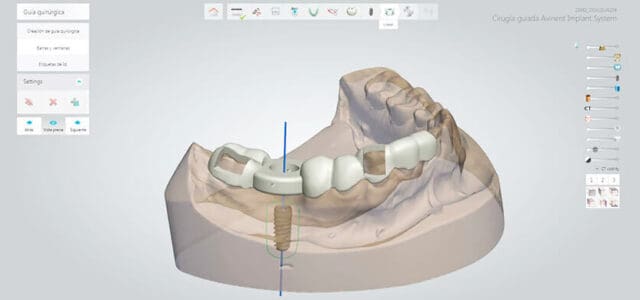 Implantes dentales