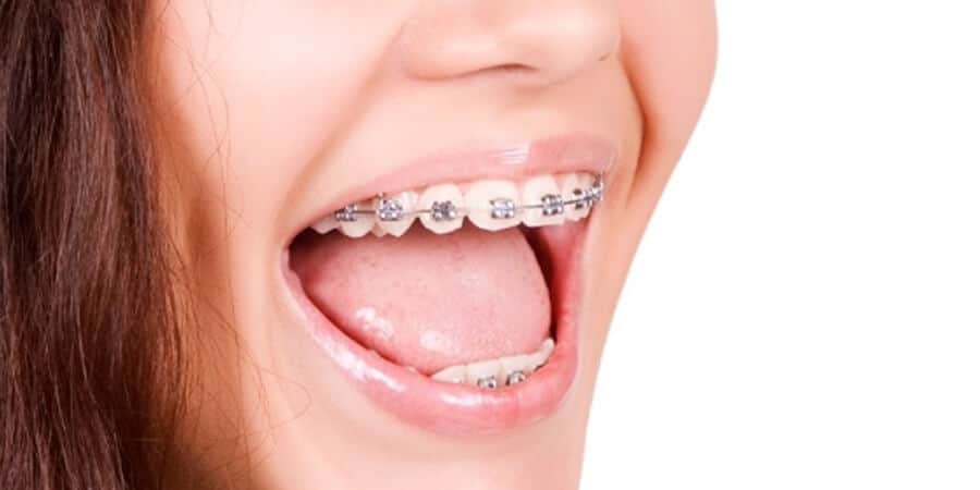 Можно по полису поставить брекеты. Можно по полису поставить брекеты. Лигатурные и безлигатурные брекеты. Спец лезгинка на брекеты. Можно по полису поставить брекеты.