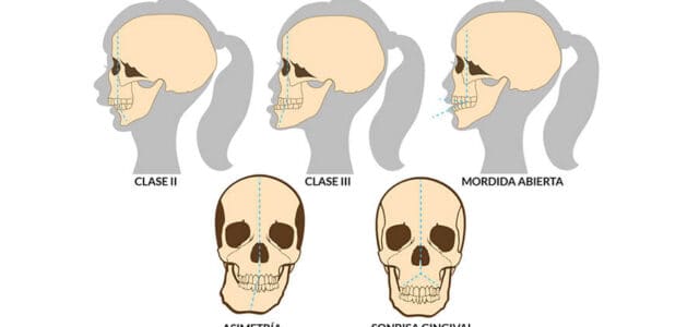 Tipos de maloclusión