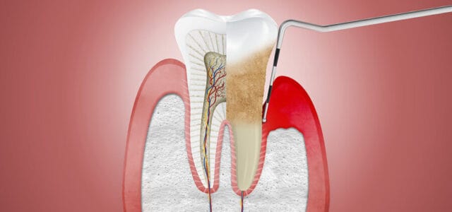 Enfermedad periodontal