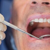Cirugía periodontal para tratar periodontitis