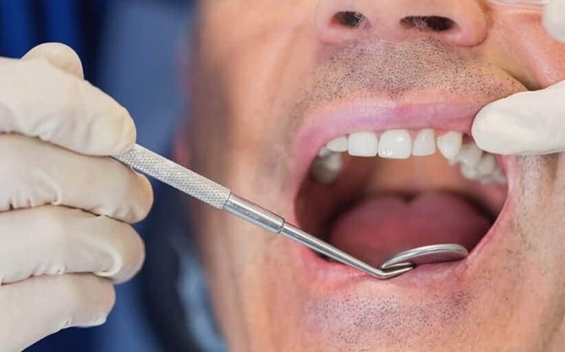 Cirugía periodontal para tratar periodontitis