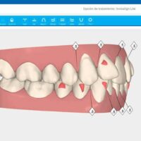 Software informático de Invisalign