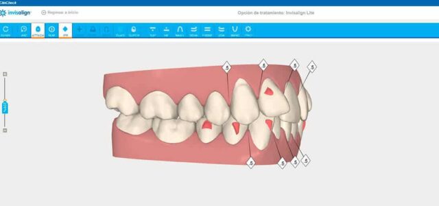 ClinCheck de Invisalign Software informático de Invisalign