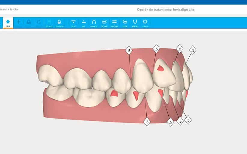 Software informático de Invisalign