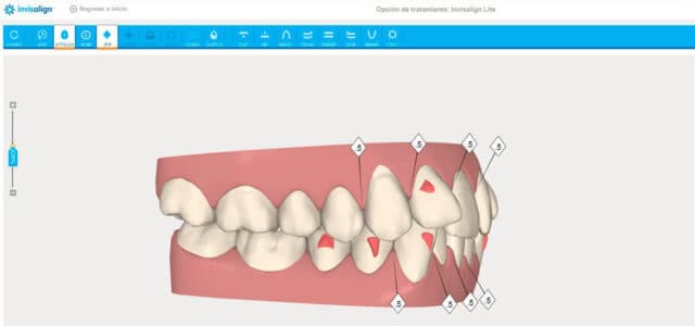 Software de Invisalign