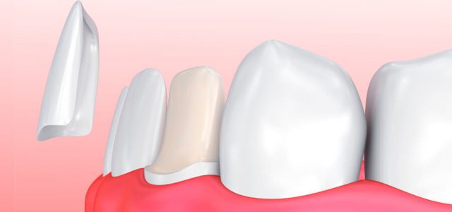 La carilla dental se adhiere al diente