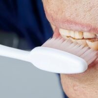 Causas y tratamiento del desgaste dental