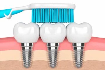 Cómo limpiar los implantes dentales