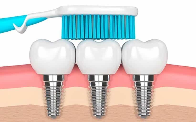 Como limpiar los implantes dentales