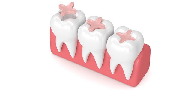 Cómo se pega una incrustación dentaria