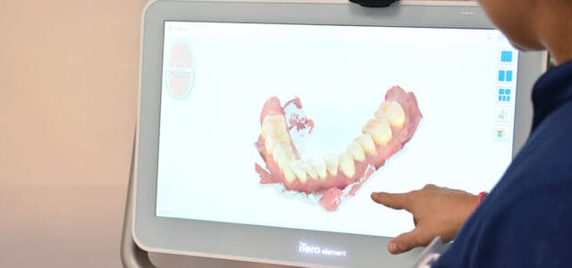 Simulación bucodental con iTero