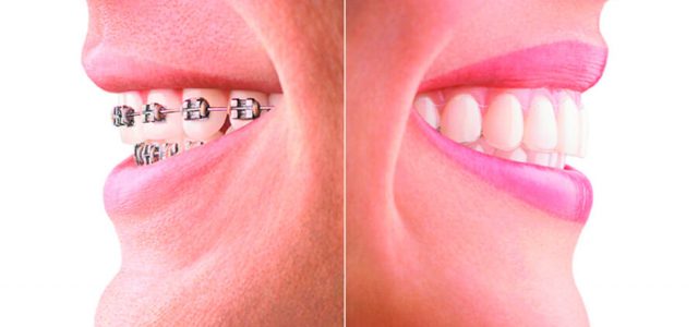 Brackets vs. Invisalign