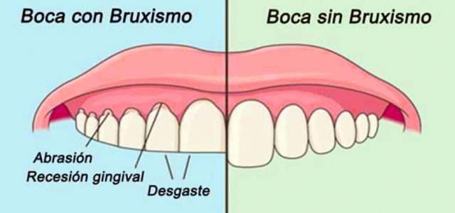 Boca normal y con bruxismo