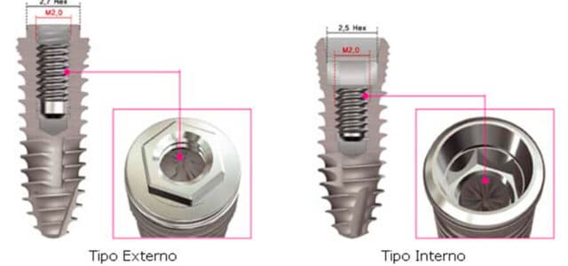 Implante dental externo