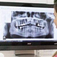 Cuidar implantes dentales