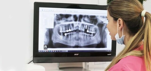 Radiografía de implantes dentales Cuidar implantes dentales
