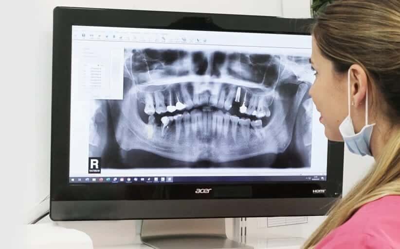 Cuidar implantes dentales