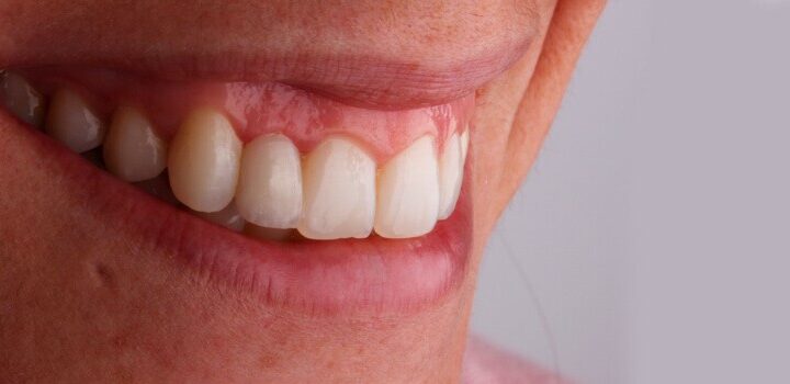 Bulto en la encía: ¿Qué es y cómo se quita? | Ferrus&Bratos