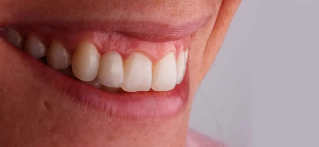 ¿Sabes qué debes hacer para tener encías sanas? | Ferrus&Bratos