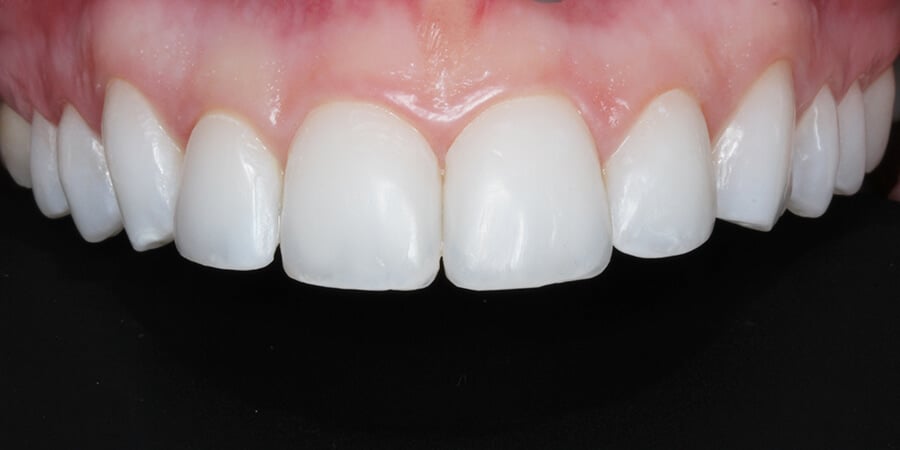 Estetica Dental Cuales Son Sus Tratamientos Ferrus Bratos