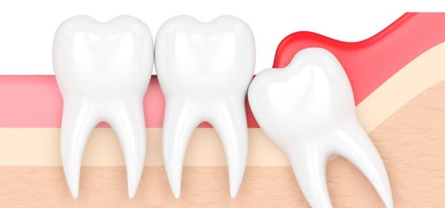 Alveolitis Dental Tipos Y Cómo Prevenir Su Aparición Ferrusandbratos 