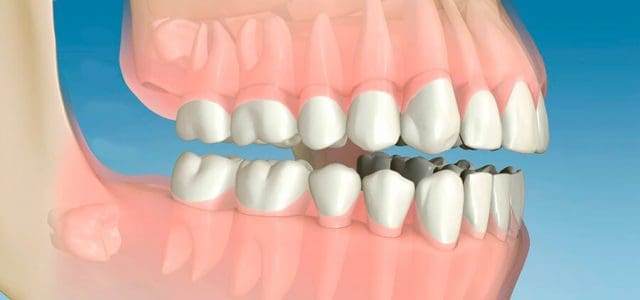 Muela del juicio sin erupcionar