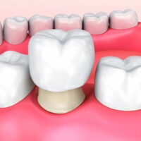 Fundas dentales hechos con zirconio
