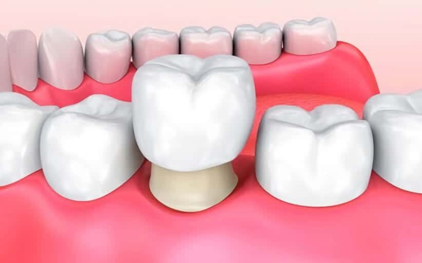 Coronas de zirconio: qué son, ventajas y precio