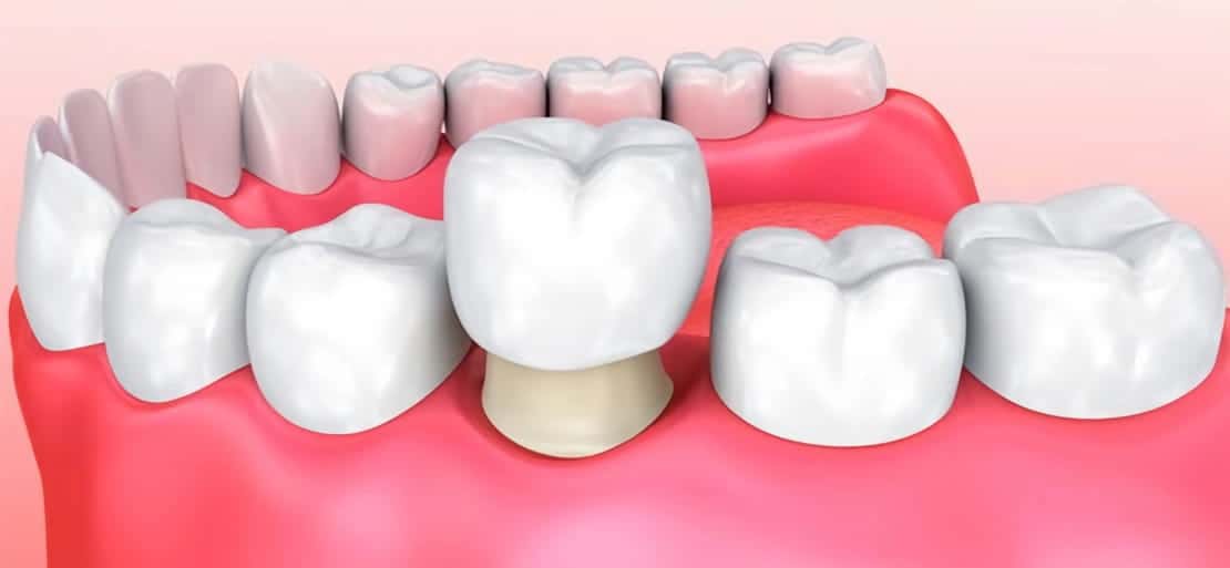 ¿Qué es una corona dental, cuándo es necesaria y qué tipos hay? • Avodent