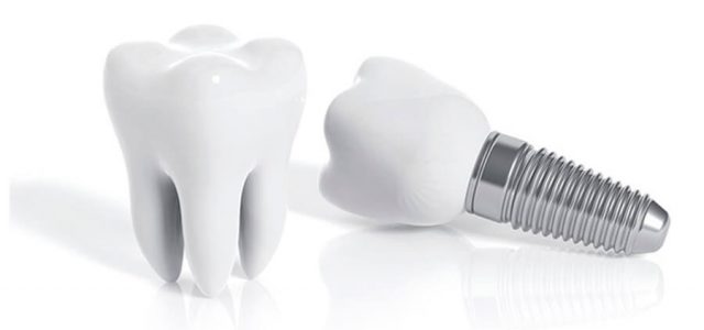 Prótesis dental fija
