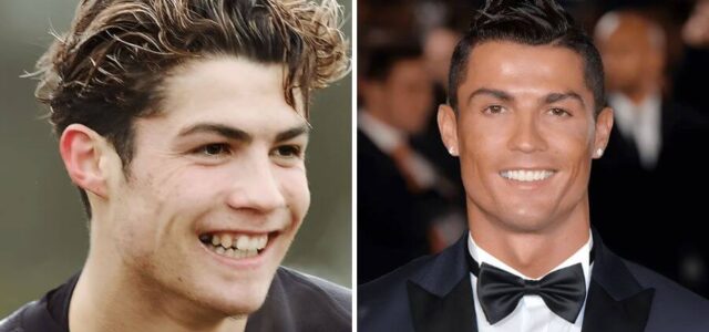 Cristiano Rondaldo con carillas dentales