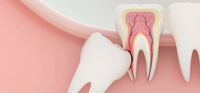 Por qué duele la erupción de las muelas del juicio