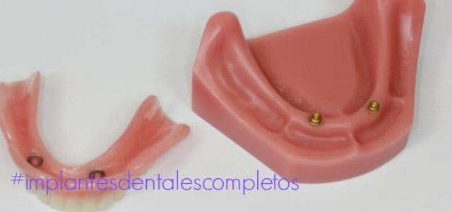 cuanto cuesta implante completo implantes dentales completos madrid