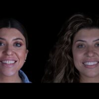 cuanto duran las carillas estéticas
